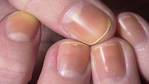爪で分かる病気や健康状態 爪11種 Ailovei