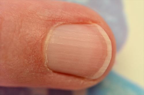爪で分かる病気や健康状態 爪11種 Ailovei